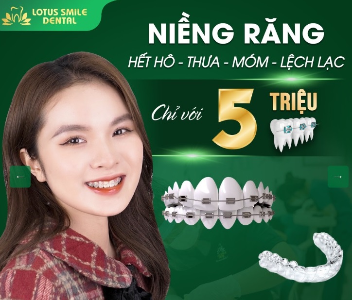 Động lực niềng răng- Thay đổi nụ cười thay đổi cuộc đời! hinh-nieng-rang