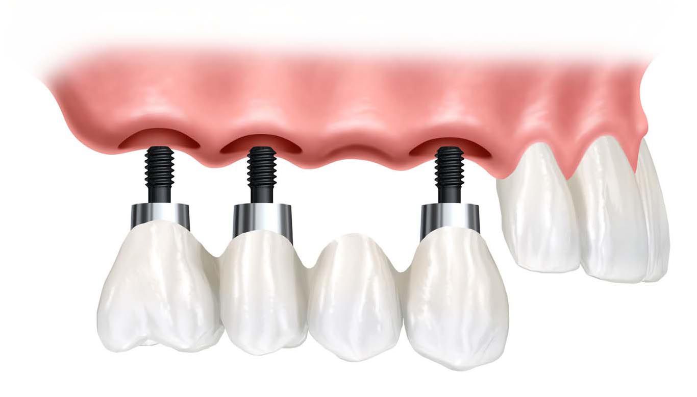 LOST 4 ADJACENT TEETH