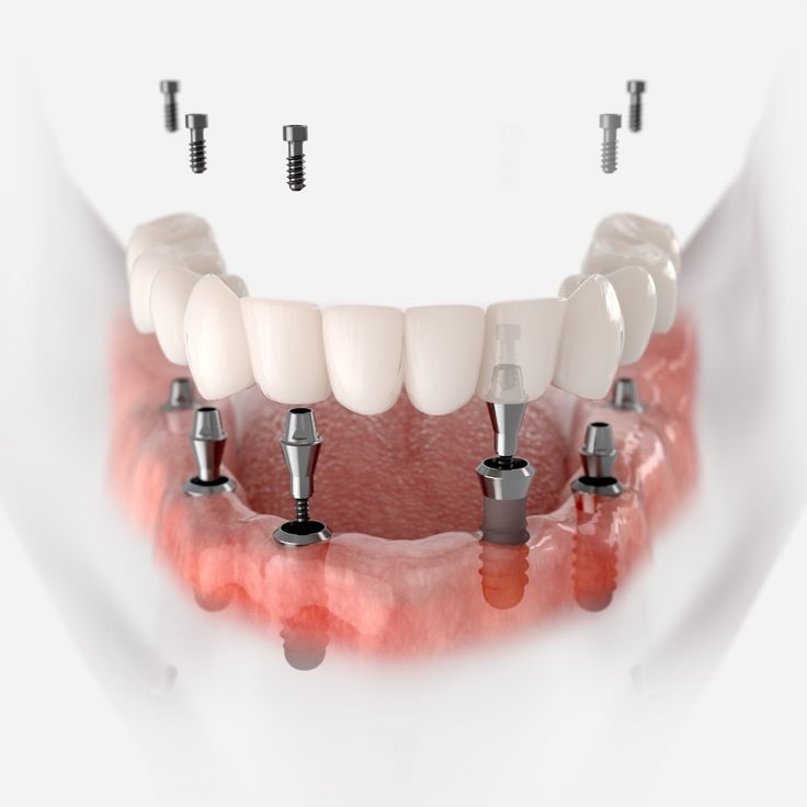 COMPLETE TOOTH LOSS