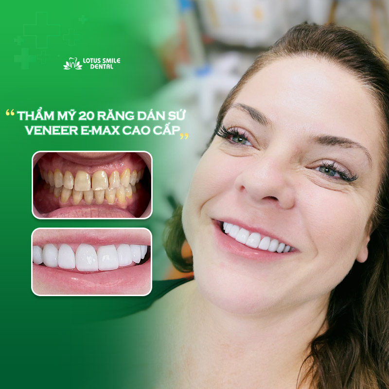 All porcelain crown and information you need to know! Khach-hang-lt-5