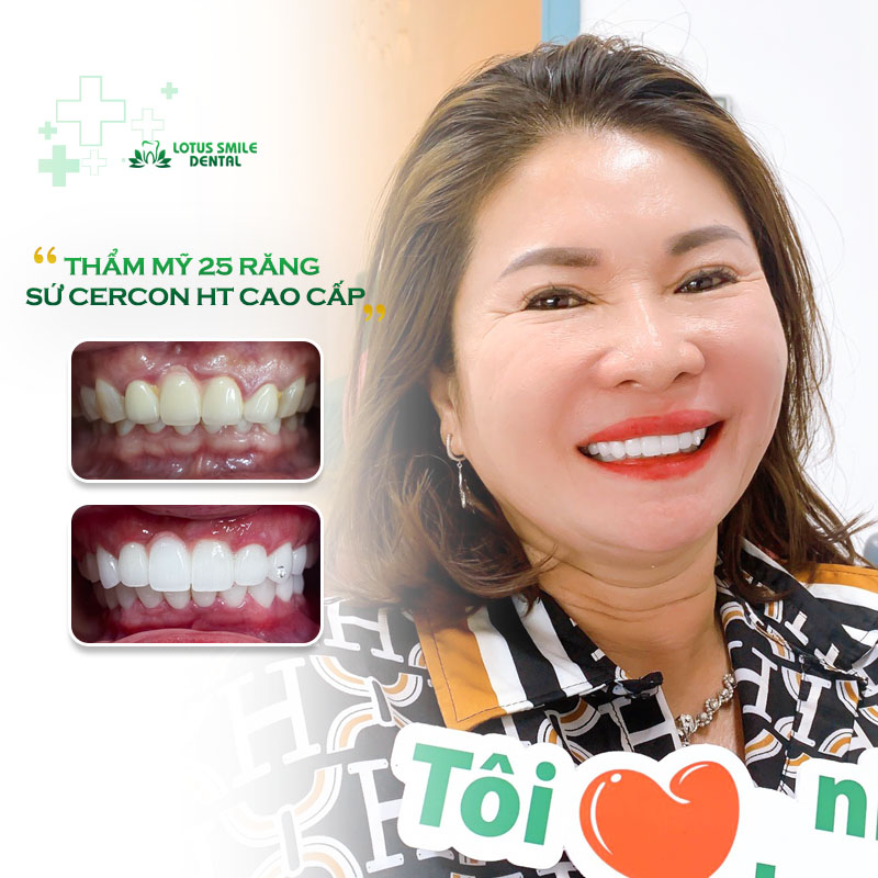 VỀ VIỆT NAM LÀM RĂNG SỨ MẤT BAO LÂU TẠI NHA KHOA LOTUS SMILE? Khach-hang-lt-6