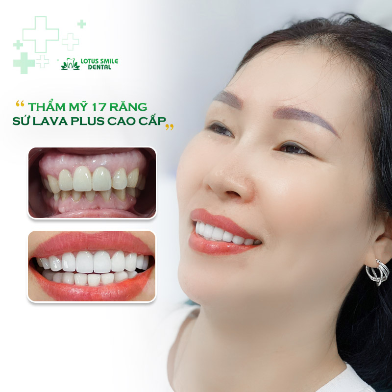 Do porcelain teeth ensure chewing ability like real teeth? Khach-hang-lt-7