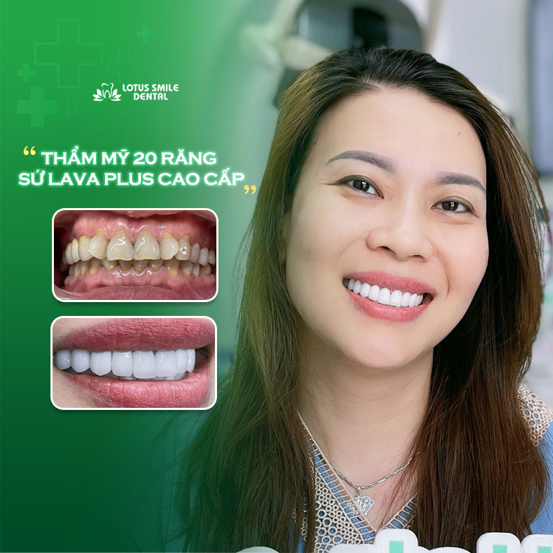 Mão Răng Sứ Là Gì? Có Những Loại Nào Trên Thị Trường? Khach-hang-lt-8