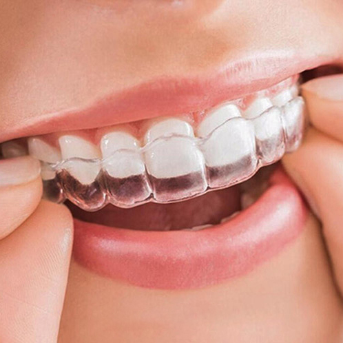 Before and after pictures of cosmetic braces nieng-rang