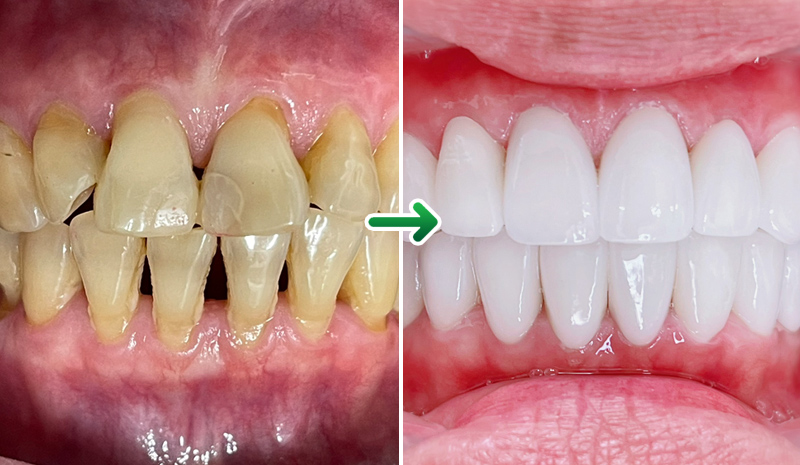 Before and after images of cosmetic porcelain crowns tinh-trang-3