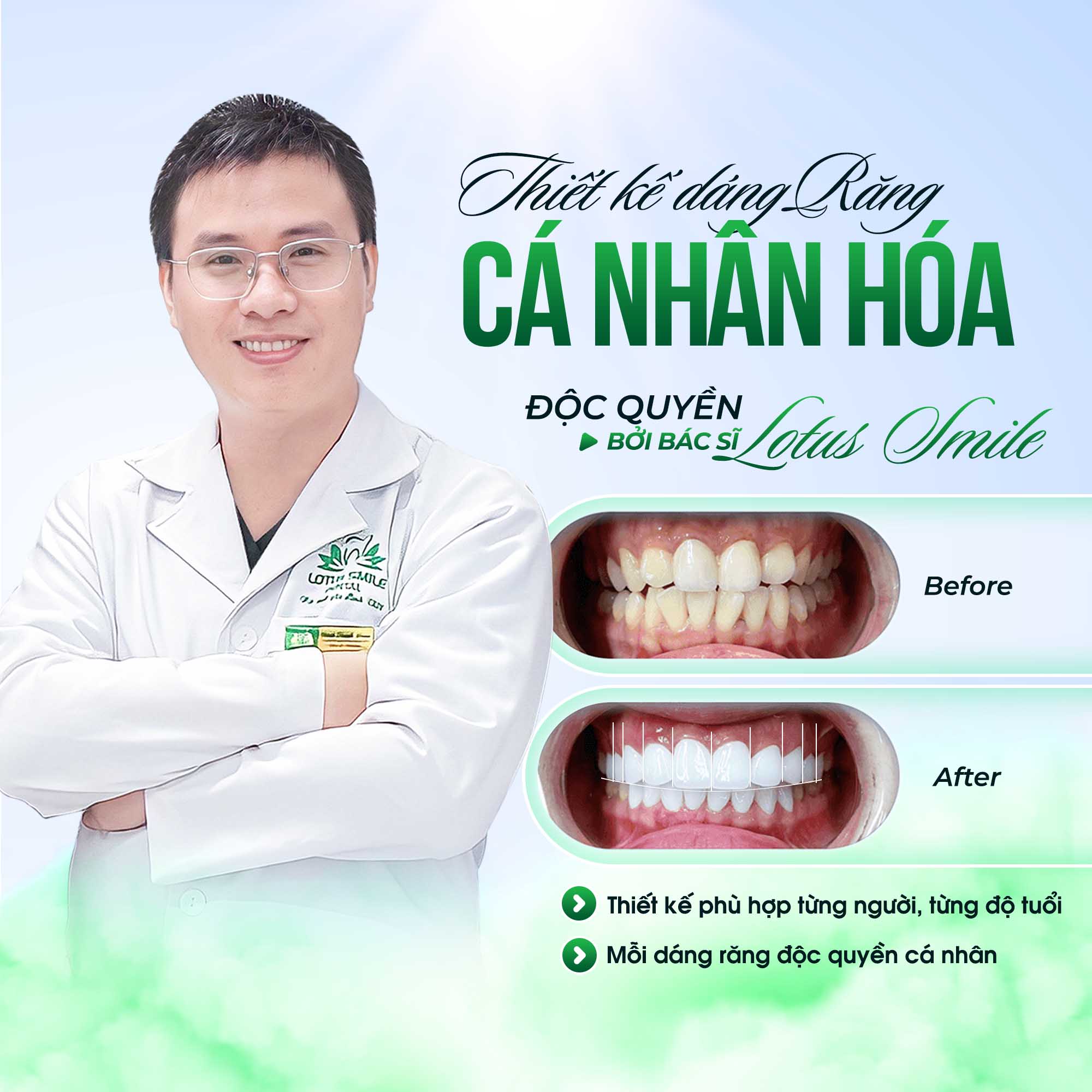 Giải pháp bọc sứ cho răng lộn xộn – Có hiệu quả không? tk-1