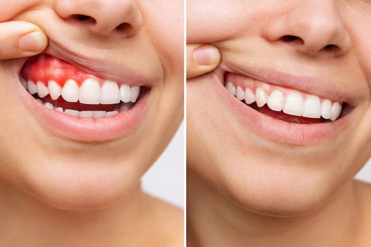 Gingivitis: Causes, Risks, and Effective Prevention bc1b8071fa7e3c9d2c92dd20931a3fbc