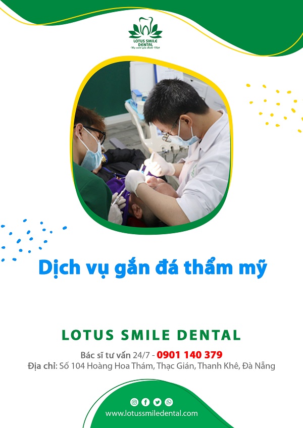 Dịch vụ gắn đá thẩm mỹ tại Nha khoa Quốc tế Lotus Smile KH-Boc-Su-tham-my-600px