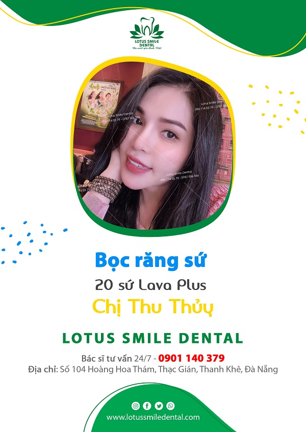 Bọc răng sứ - Giải pháp hoàn hảo khắc phục các tình trạng của răng kh-chi-thu-thuy-20-rang-su-lava-plus-600px